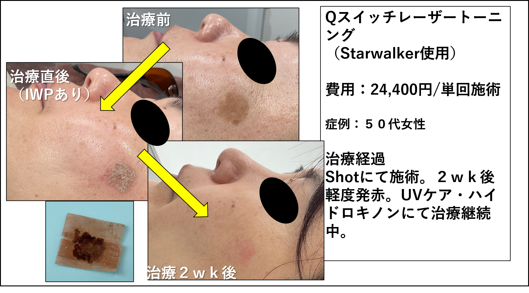 シミ治療 | 医療脱毛・シミ治療・メディカルア―トメイクなら三鷹
