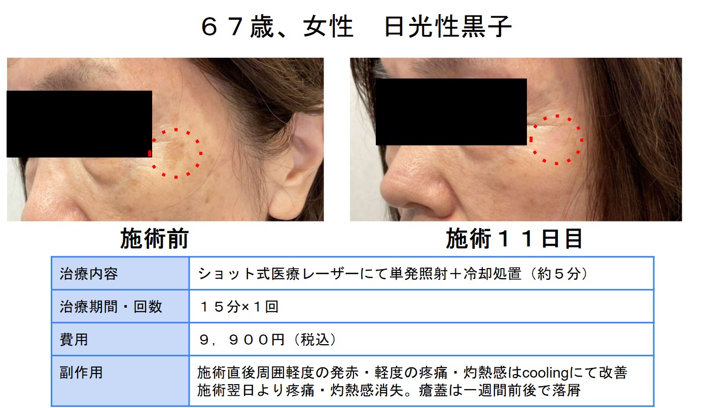 シミ治療 | 医療脱毛・シミ治療・メディカルア―トメイクなら三鷹 シミ治療 | 医療脱毛・シミ治療・メディカルア―トメイクなら三鷹