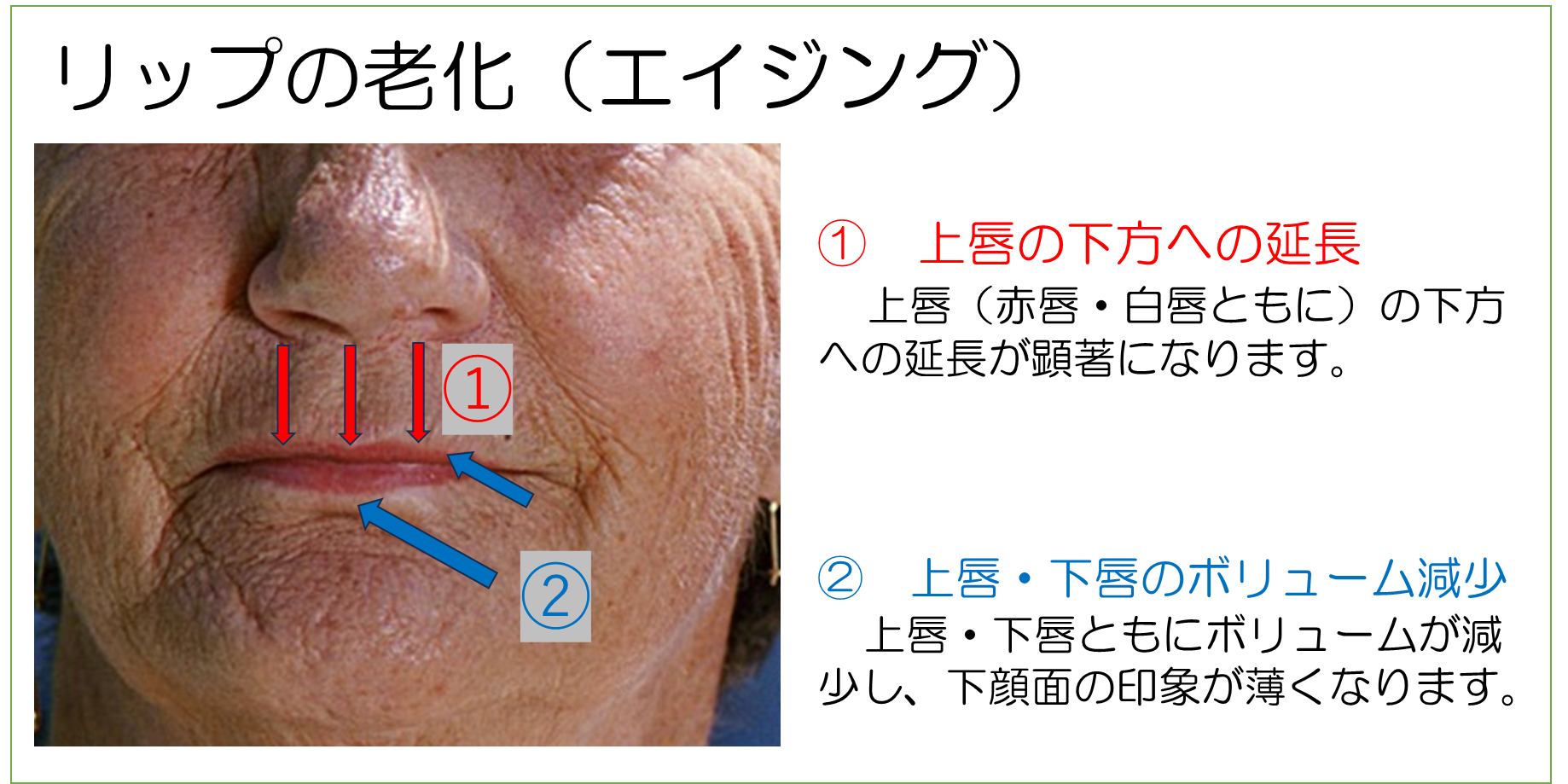 三鷹ヒロクリニックのスマイルリップ