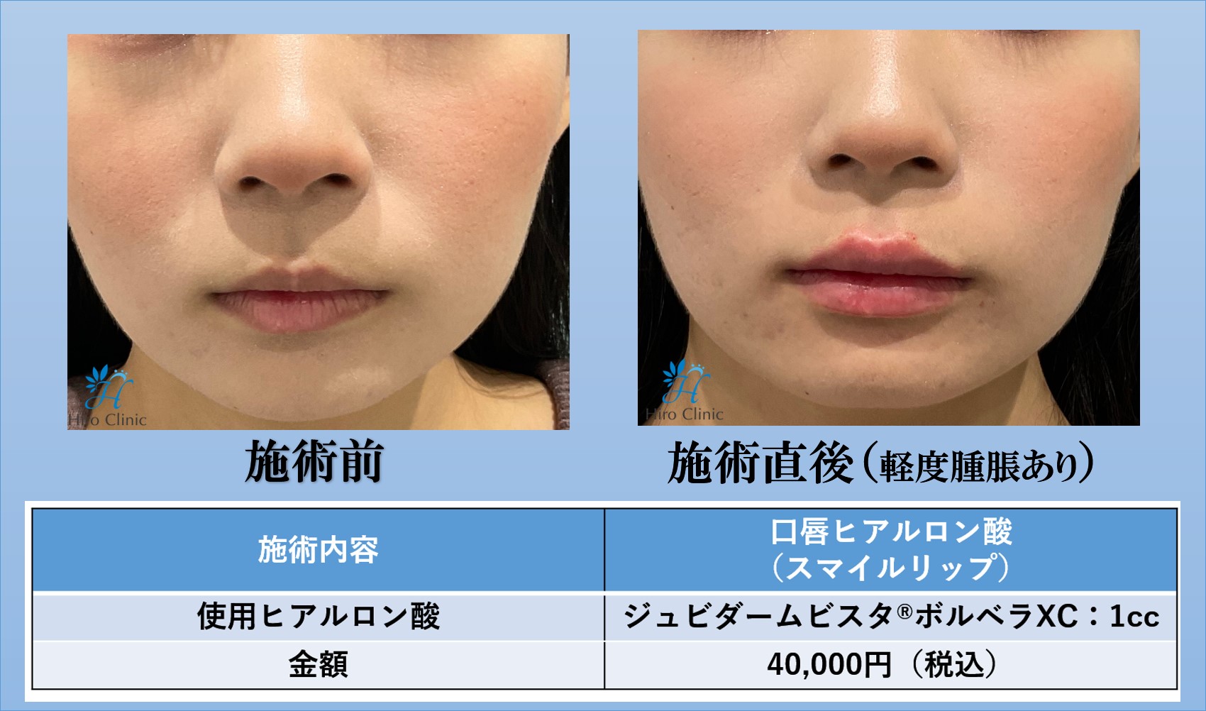 三鷹ヒロクリニックのスマイルリップ