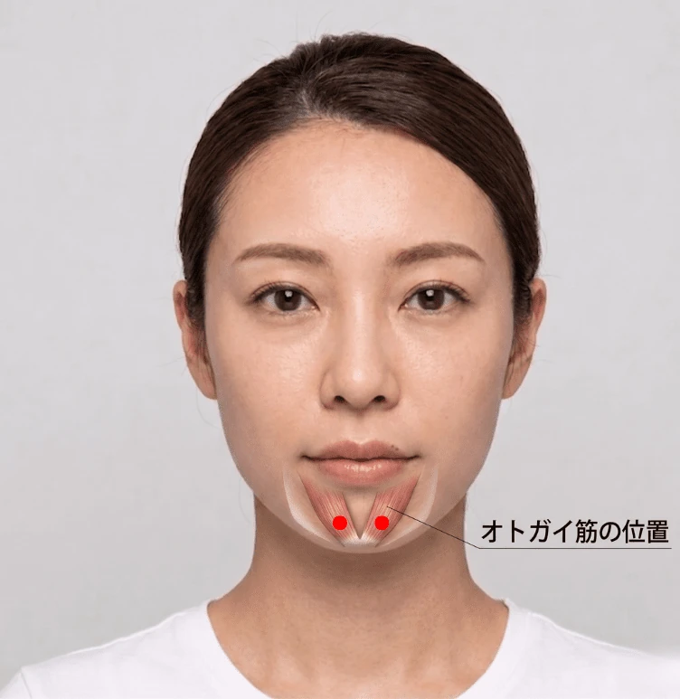 あごのオトガイ筋の位置とボトックスの注射点を示した図